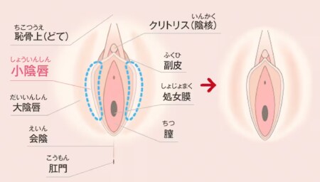 「小陰唇縮小術」とは？