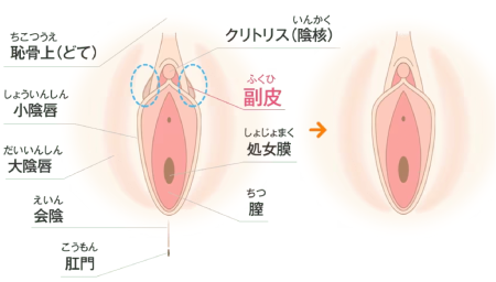 「副皮除去術」とは？