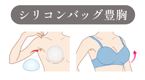 シリコンバッグ豊胸術
