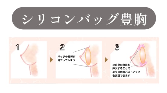 ハイブリッド豊胸