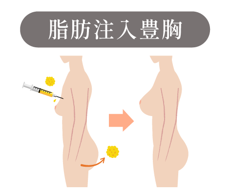 脂肪注入豊胸術