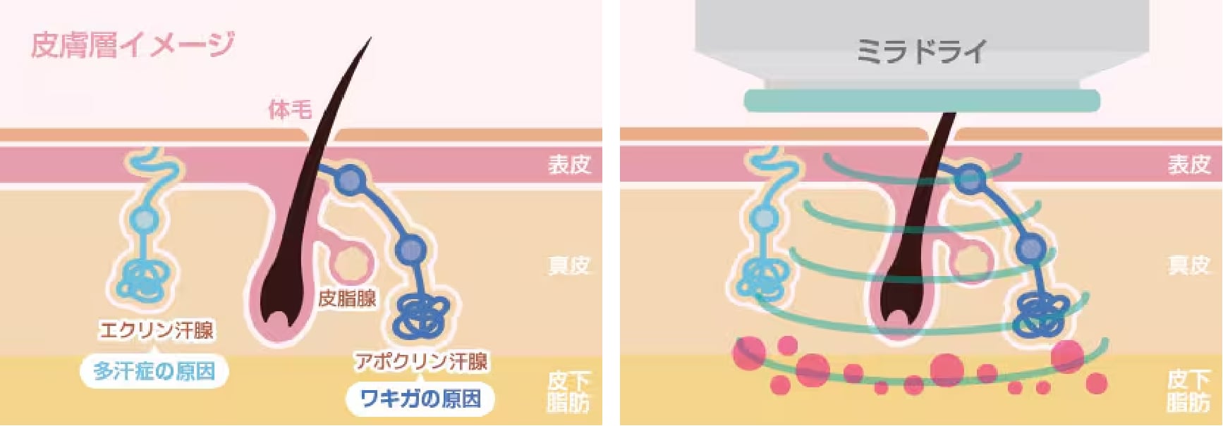 ミラドライとは？