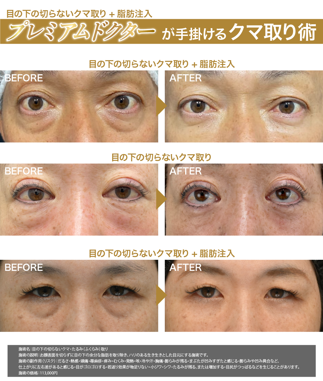 史上最年少で就任🌟クマ取りプレミアムドクターによる【クマ取り】