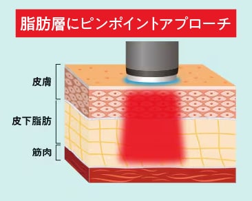 【脂肪を溶かす】最新の小顔&痩身治療