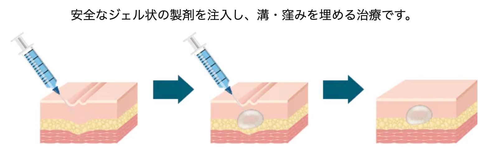 ヒアルロン酸注入とは