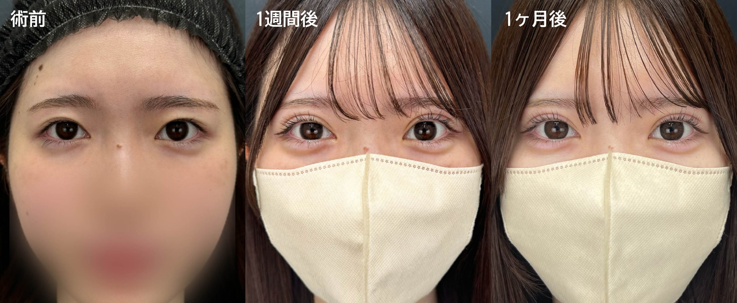 【二重埋没法】による印象の変化