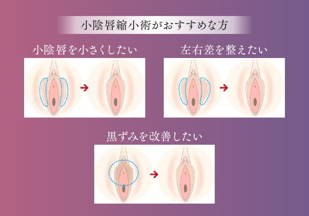 【小陰唇縮小術】