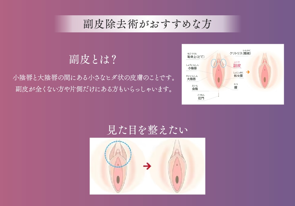【副皮除去術】