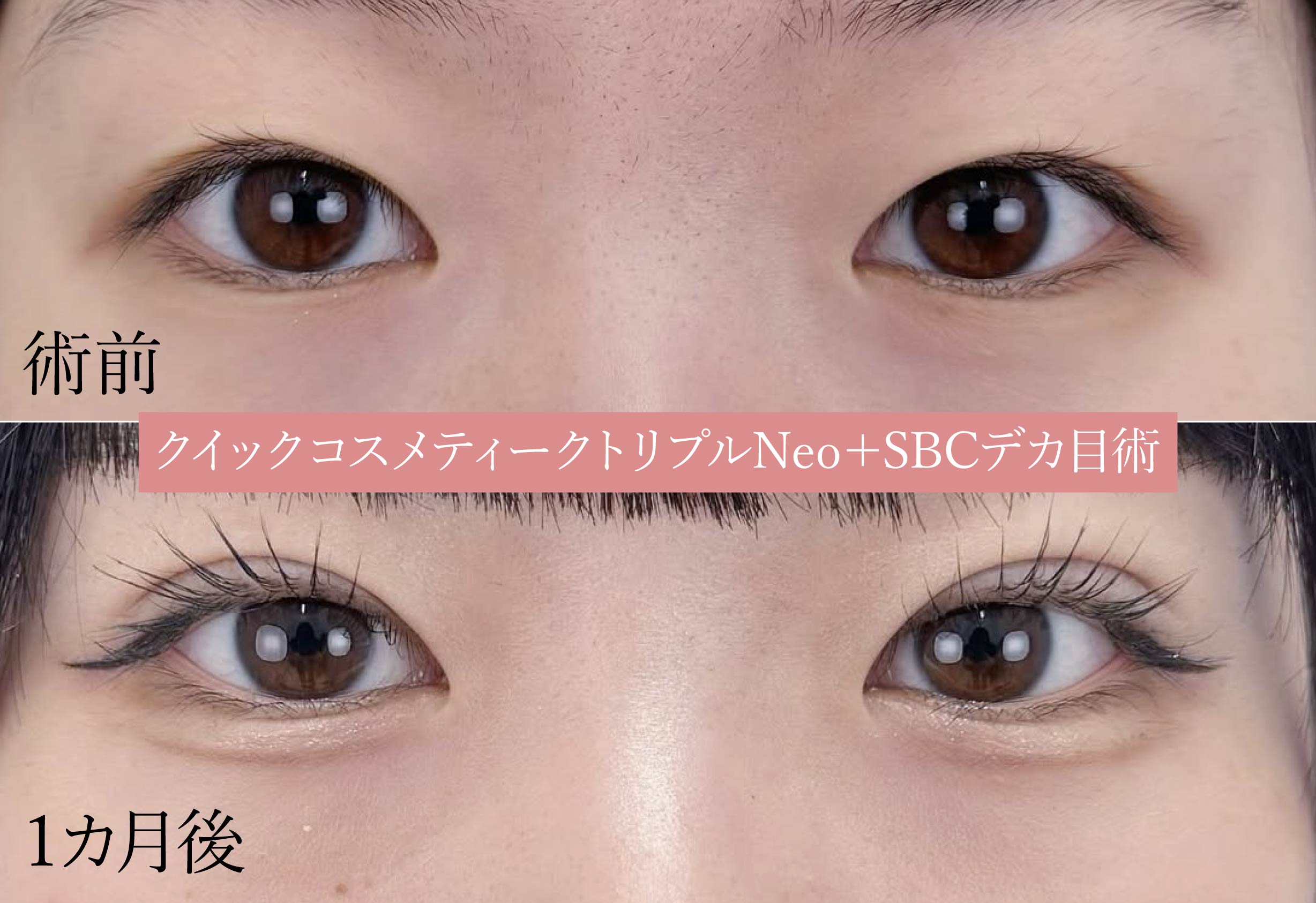 🔸クイックコスメティークトリプル＋ＳＢＣデカ目術