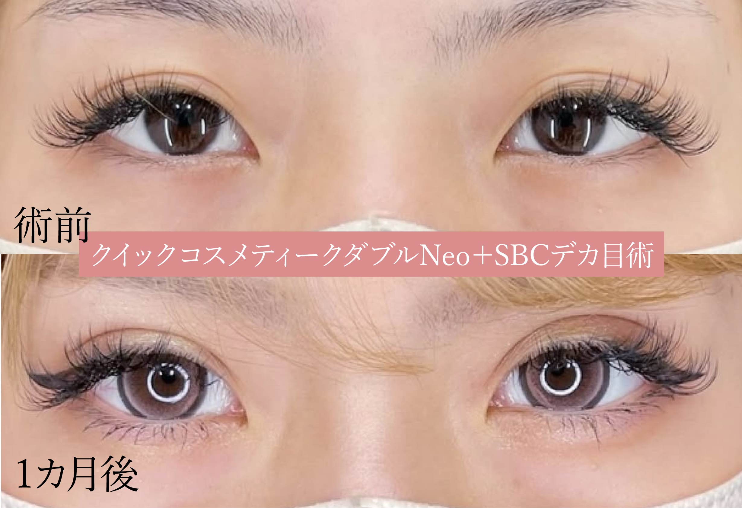 🔸クイックコスメティークダブル＋ＳＢＣデカ目術