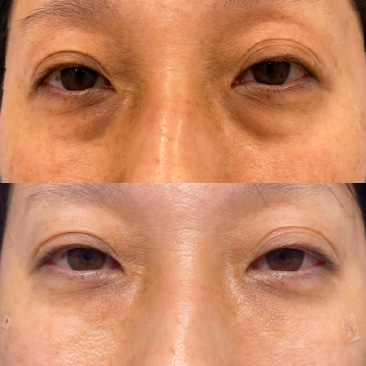 目の下の切らないクマ・たるみ取り+コンデンスリッチ（目の下〜ゴルゴ）+ナノリッチ（目の下）