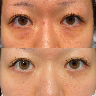 目の下の切らないクマ・たるみ取り+コンデンスリッチ（目の下〜ゴルゴ）+ナノリッチ（目の下）