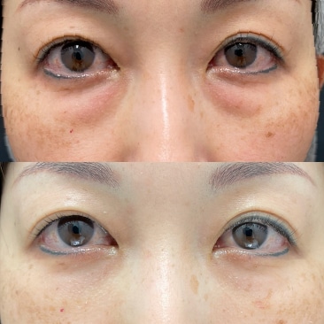 目の下の切らないクマ・たるみ取り+コンデンスリッチ（目の下〜ゴルゴ）