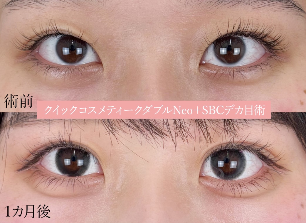 🔸クイックコスメティークダブル＋ＳＢＣデカ目術