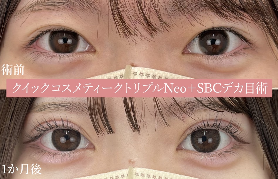 🔸クイックコスメティークトリプル＋ＳＢＣデカ目術