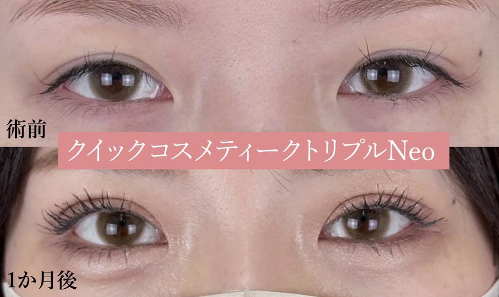 🔸クイックコスメティークトリプル