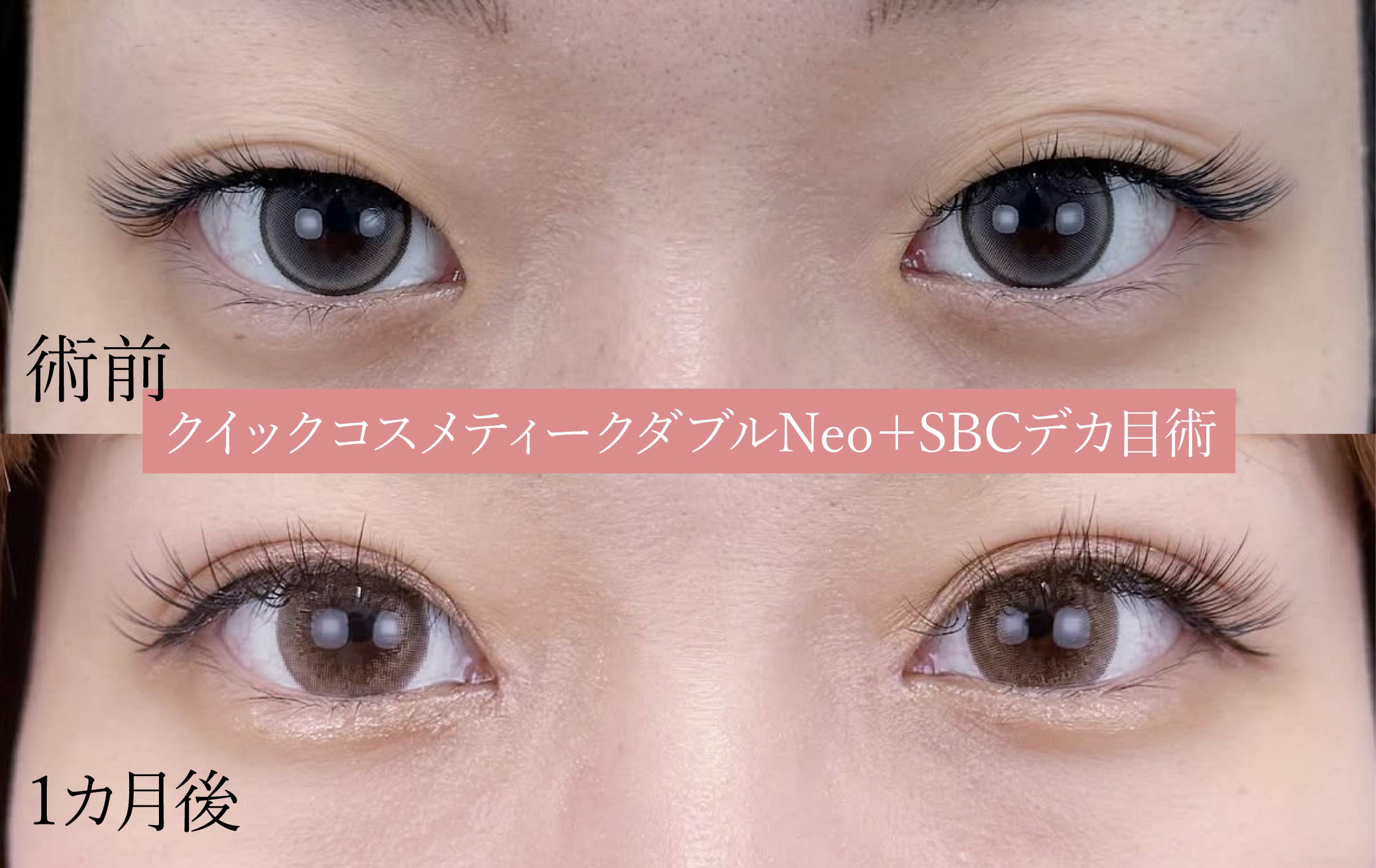 韓国で人気の目つき矯正も得意