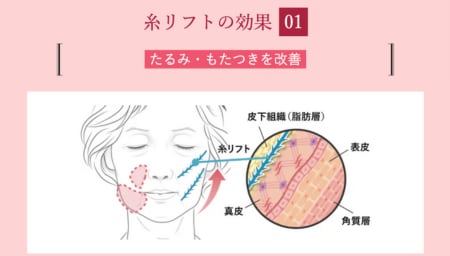 通常の糸リフト