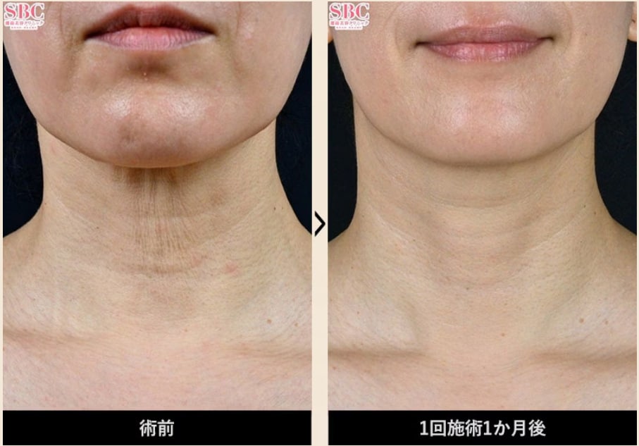 症例写真2：首のシワ