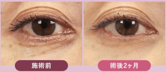 症例写真：リジュランi