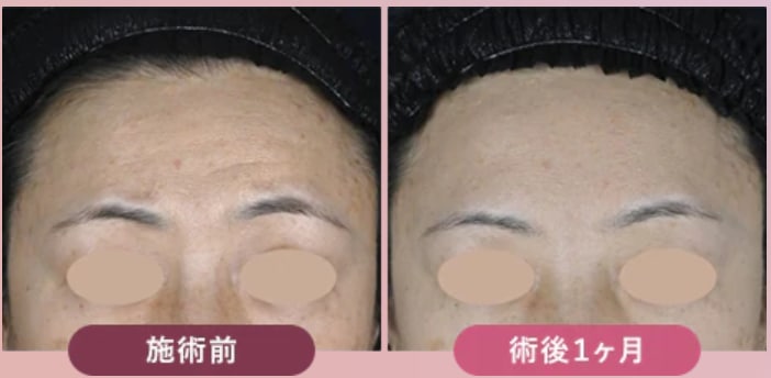 症例写真：リジュランHB