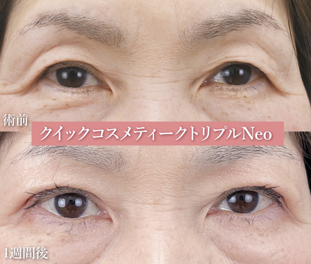 【６０代女性：クイックコスメティークトリプルNeo】