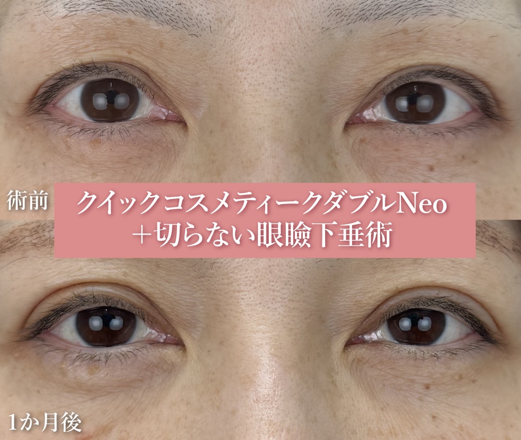 【５０代女性：クイックコスメティークダブルNeo＋切らない眼瞼下垂術】