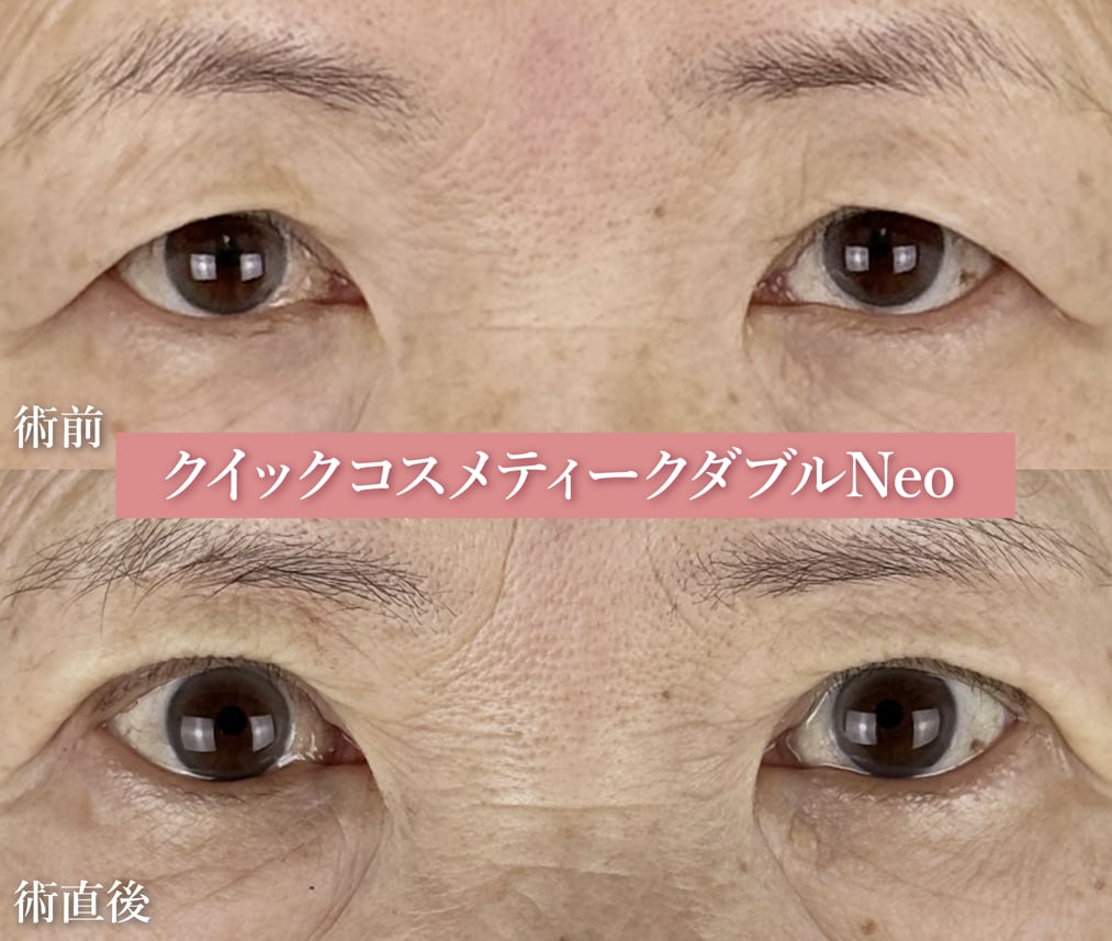 【７０代女性：クイックコスメティークダブルNeo】