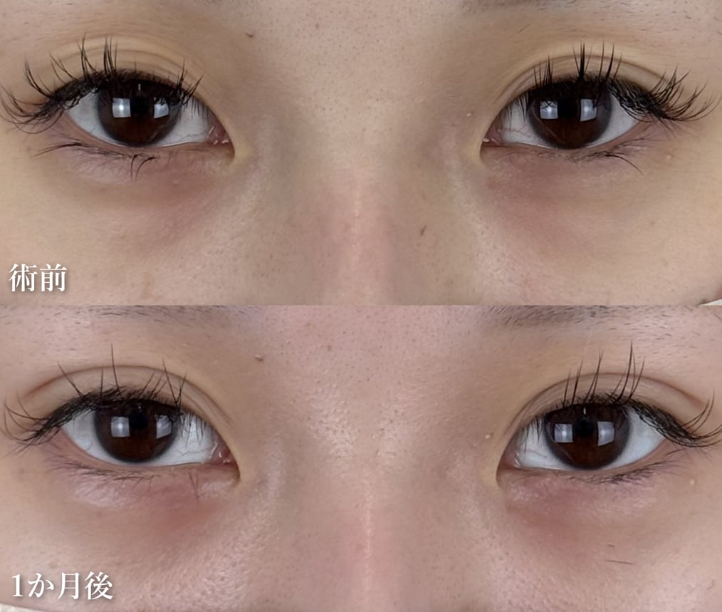 二重埋没法×クマ取り