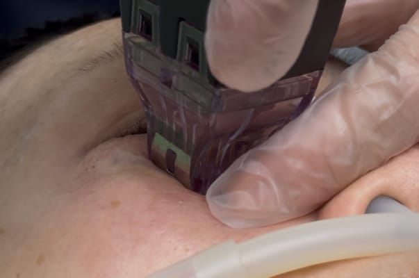 東北初上陸の最新レーザー🌟