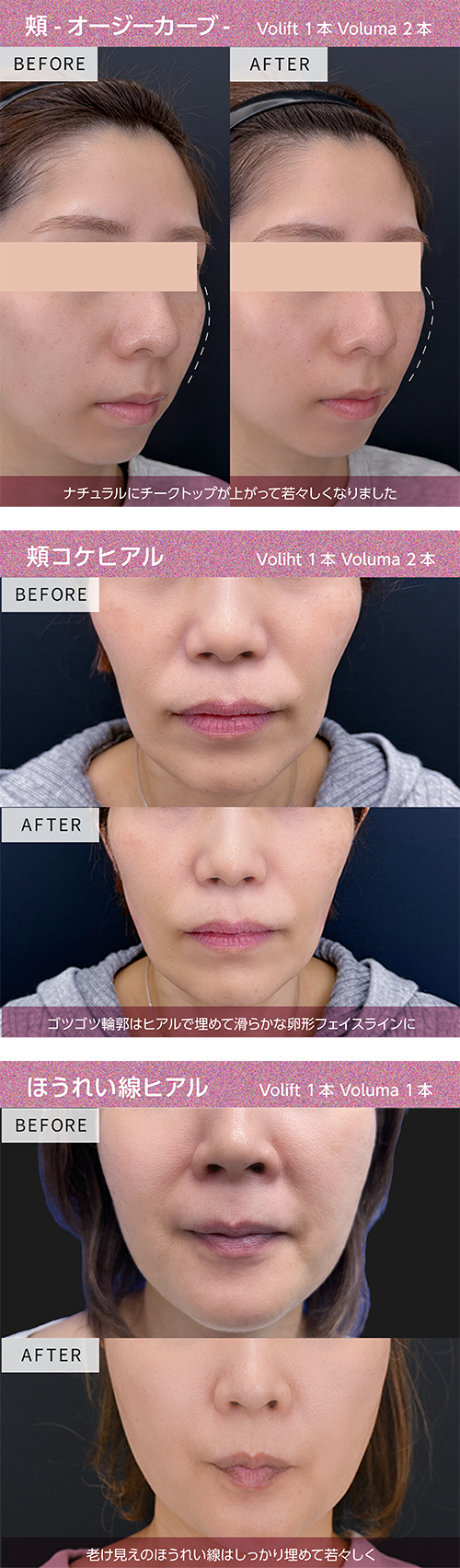 頬・ほうれい線・オージーカーブ