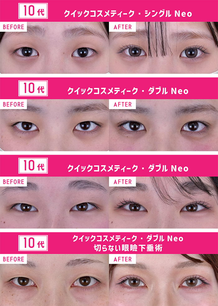 学生が多めの10代。<br />
学校でもすっぴんでも浮かない【末広型】の自然なデザインが人気🌟