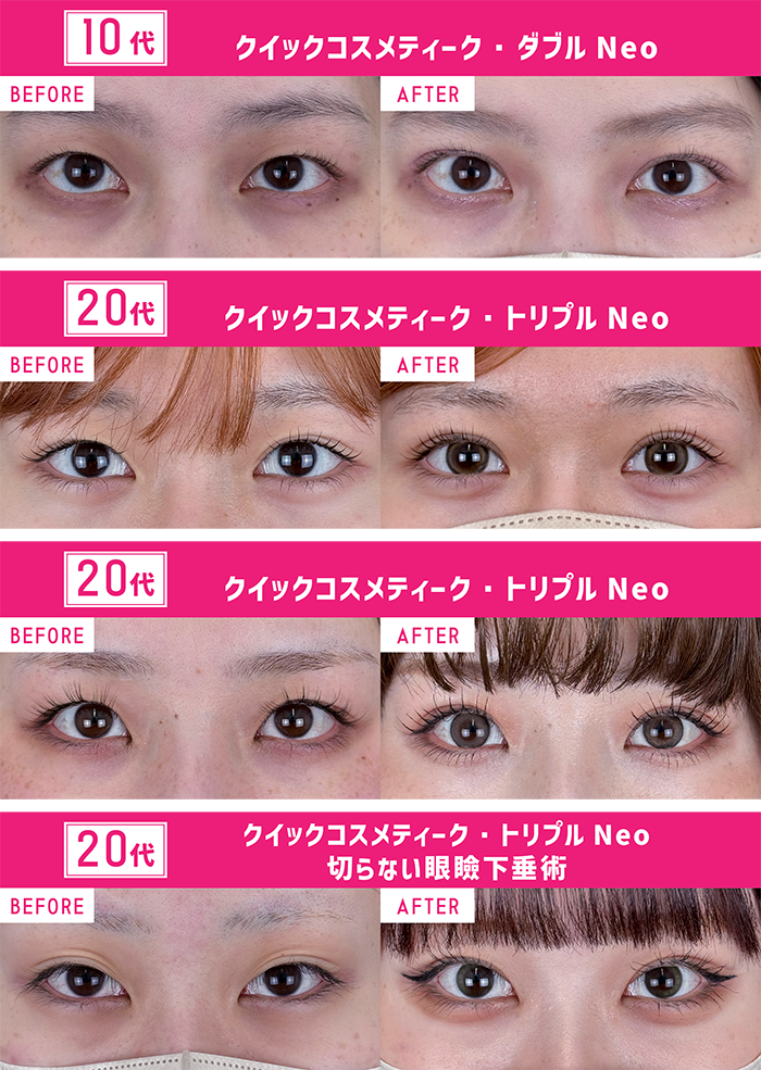 【メイク映え】も譲れない！<br />
【MIX型】【平行型】のデザインが人気💓