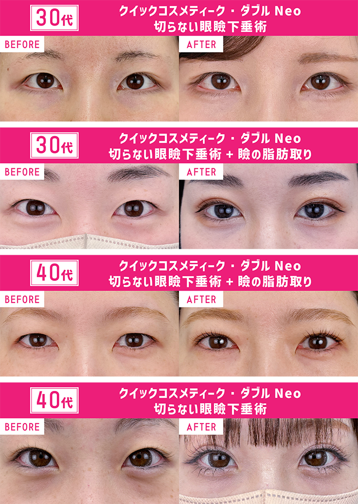 加齢とともに気になるたるみ。<br />
埋没二重は【アンチエイジング】でもあるんです！