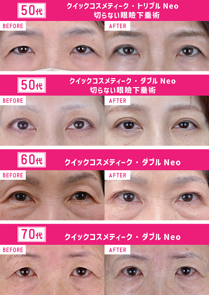 お子さんと一緒に二重整形する方も🌟<br />
埋没で叶うクイックアンチエイジング