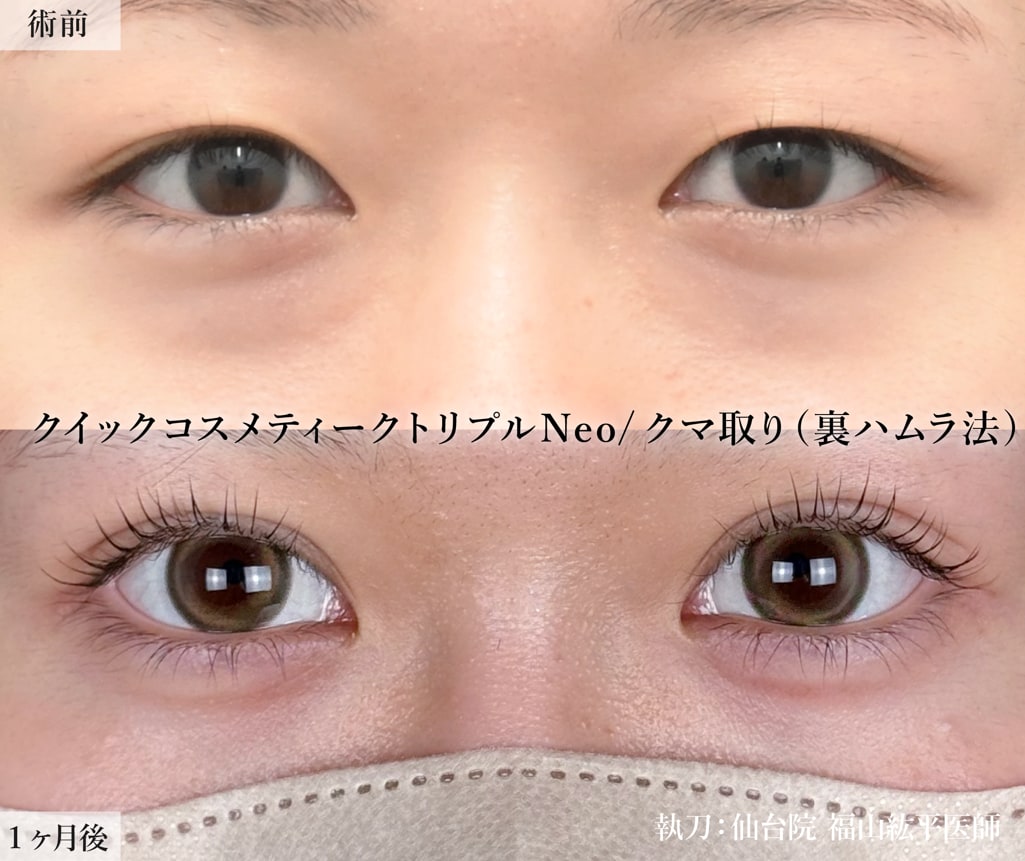 施術時間１０分で垢抜け二重が手に入る！