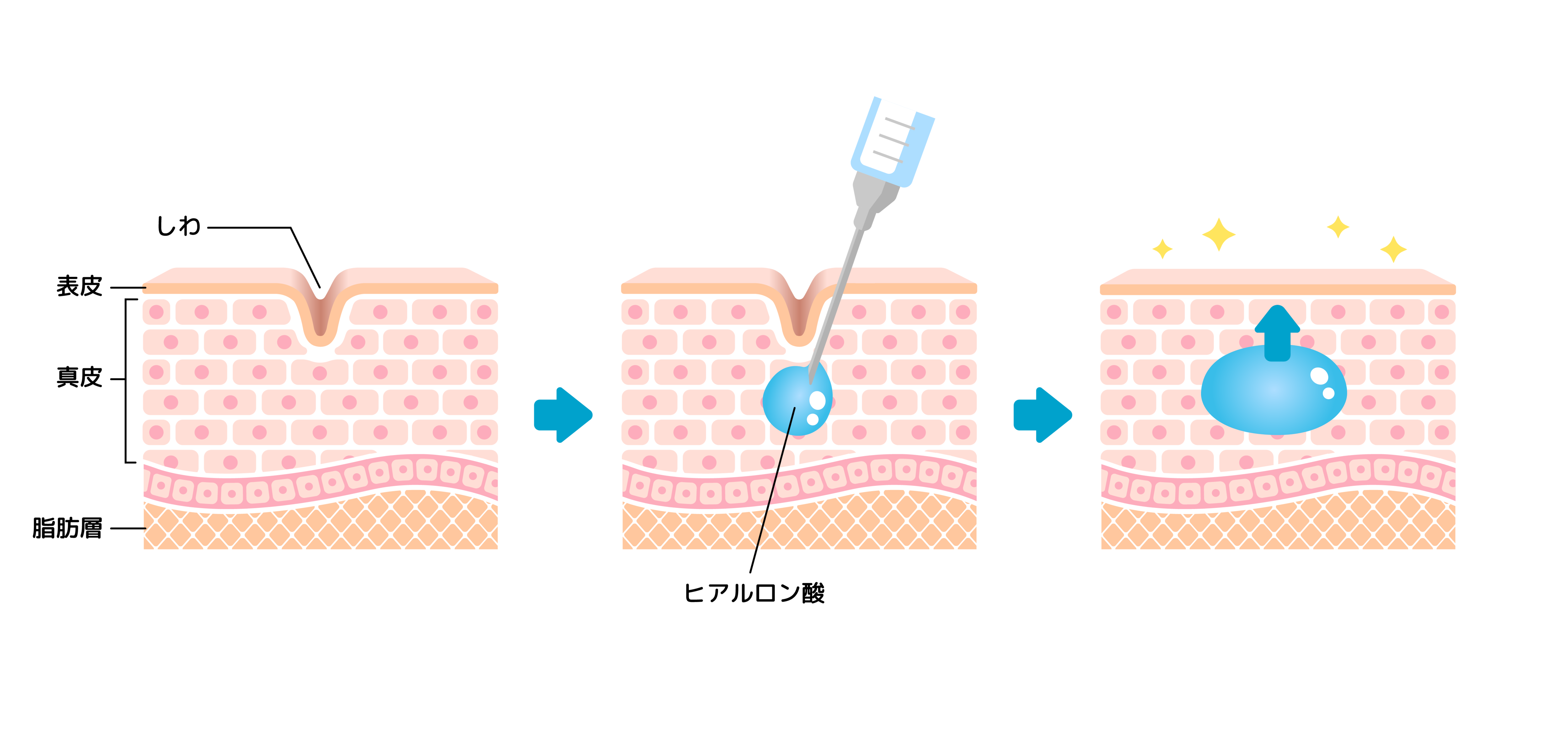 ヒアルロン酸注入とは