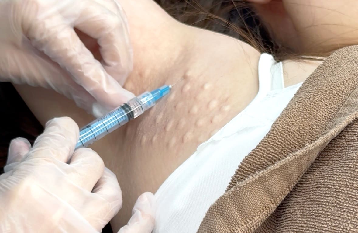 わきボトックスとの違い