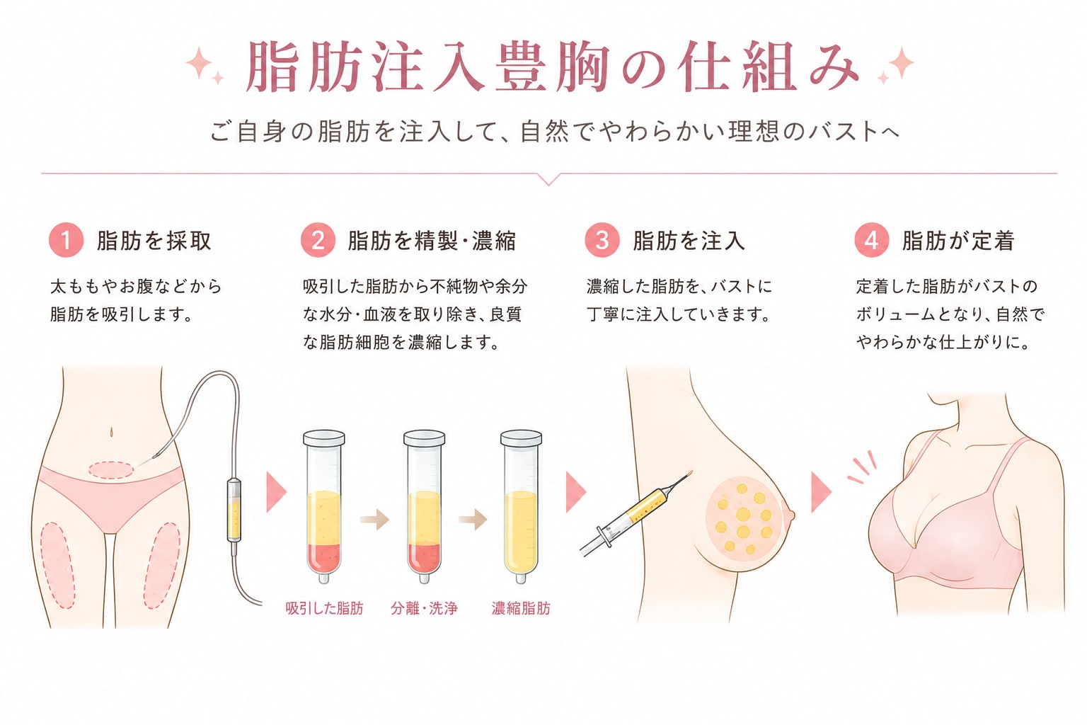 脂肪注入豊胸の仕組み