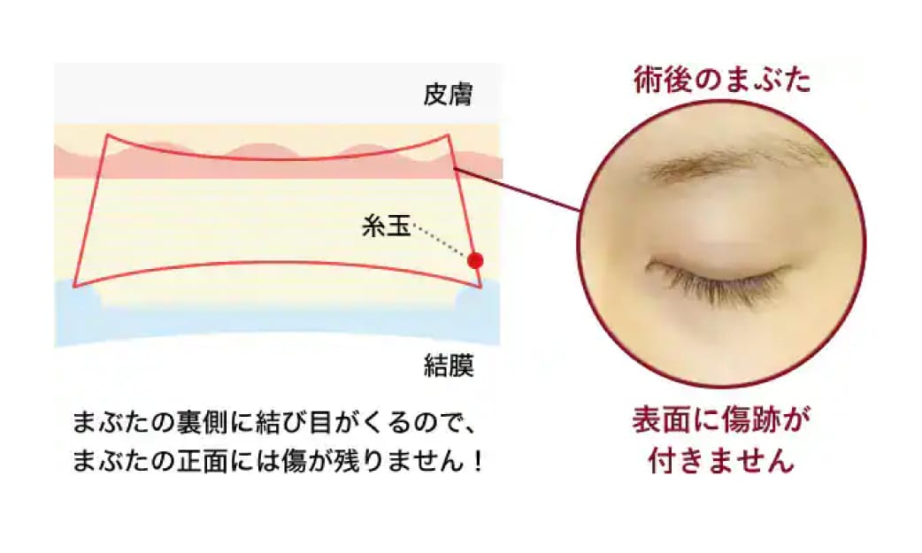 切らずに二重を作る埋没法とは
