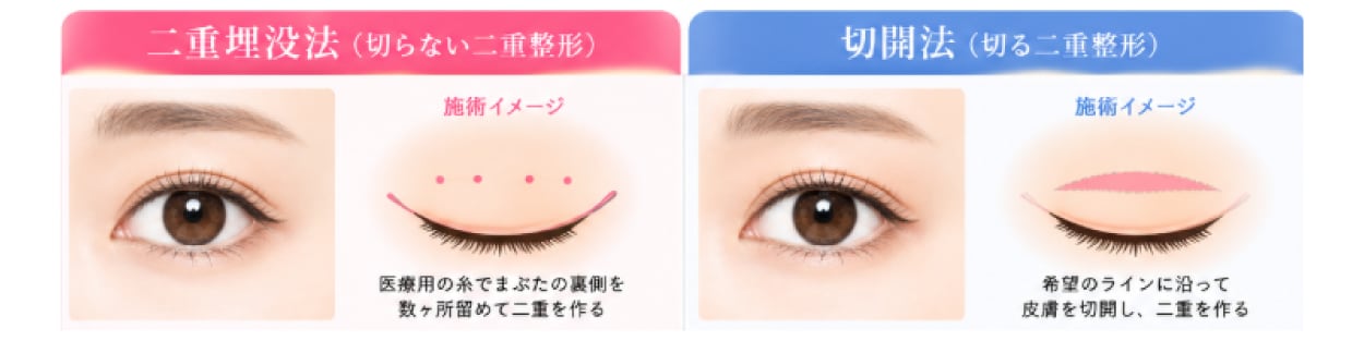 切開法との違いとメリット