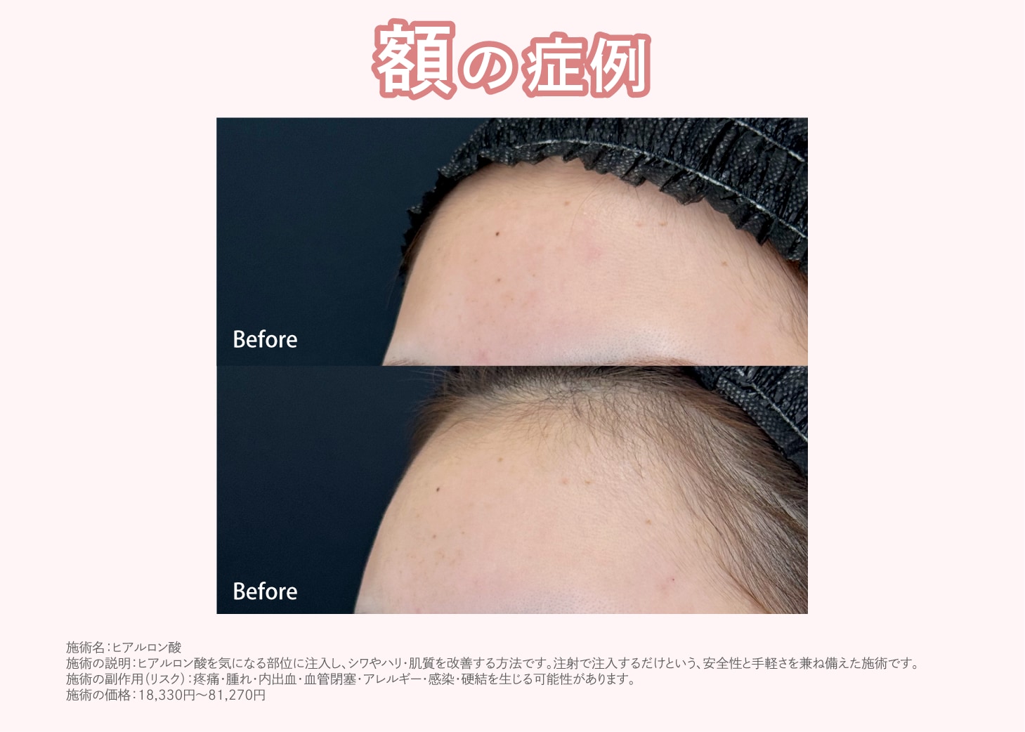 額を丸くつるんとさせたい（ボリューマXC）<br />
