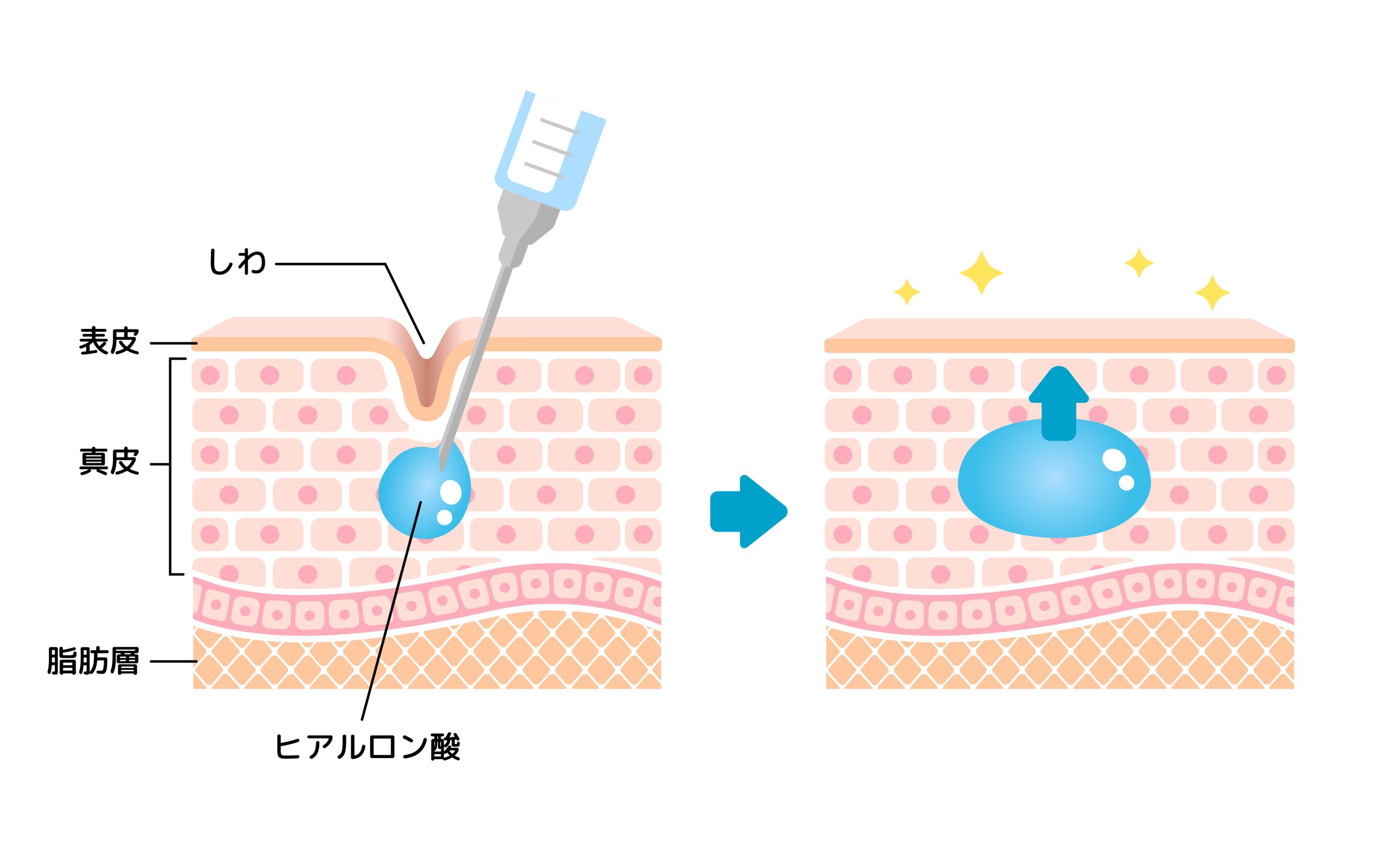 ヒアルロン酸注射の仕組み