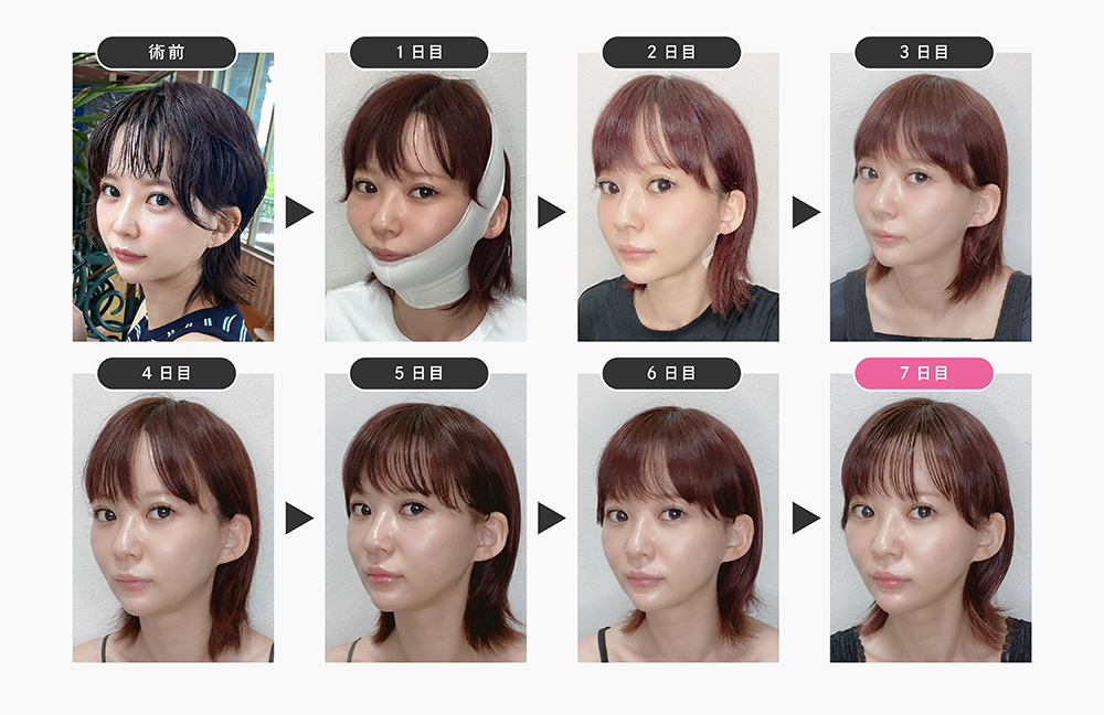 ベイザー併用アキーセル脂肪吸引<br />
ーホホ+アゴ下+エラ下ー