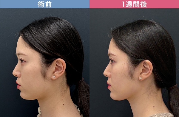 術後1週間～1か月