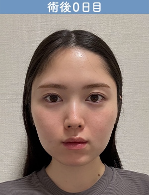術直後