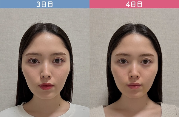 術後３日-４日目