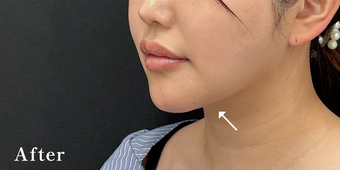 小草先生によるお得な脂肪吸引注射モニター