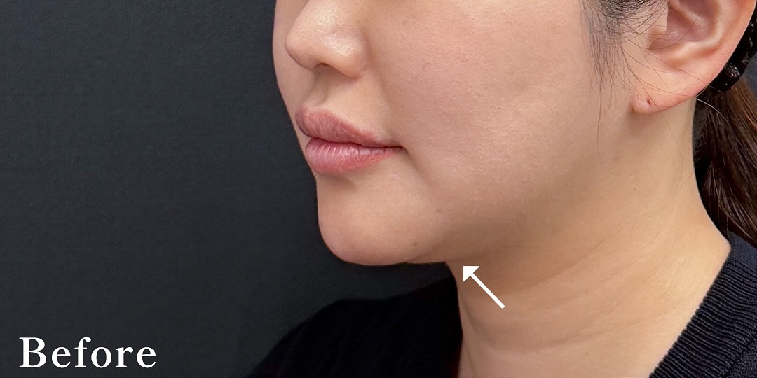 小草先生によるお得な脂肪吸引注射モニター