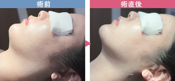 最小限のダウンタイムで自然な仕上がり